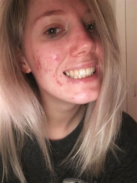 Beauty Blogger Who Was Too Scared To Leave House Without Being Caked In