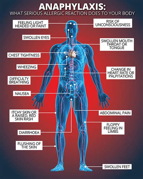 Anaphylaxis Do You Know The Symptoms Of A Severe Allergic Reaction
