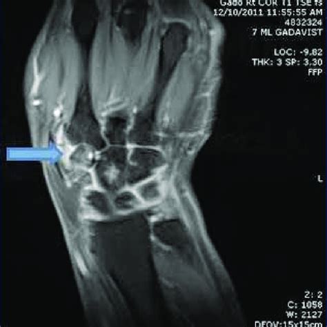 Mri Of Right Wrist Showing Avascular Necrosis Of Trapezoid Download