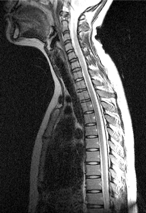 Propriospinal Myoclonus Induced By A Herniated Lumbar Intervertebral