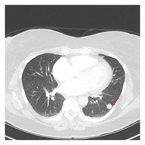 Ct Pulmonary Angiogram Performed The Same Day As The Chest Radiograph