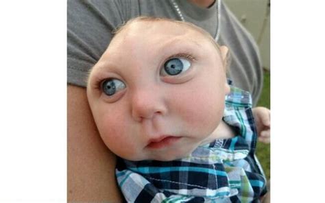 Sentimos Os Olhares Diz Pai De Bebê Que Nasceu Sem Parte Do Crânio E