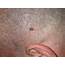 Skin Cancer On Scalp Prevention Tips For Bald Men » Scary Symptoms
