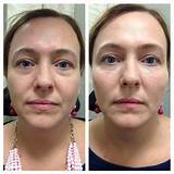 Pictures of Fillers For Under Eye Bags Side Effects