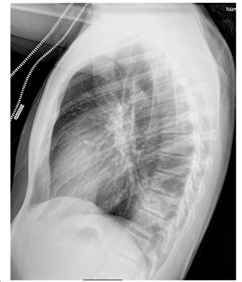 Left Lateral Chest X Ray Performed On Day 14 Showing An Improvement Of