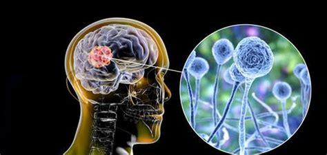 Es una infección aguda, a menudo mortal, que se produce por hongos del orden mucorales. Mucormicosis: ¿por qué afecta a los pacientes de ...