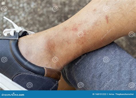 Skin Disease Winter Healthcare Dry Cracking Skin And Rash Red Of Leg