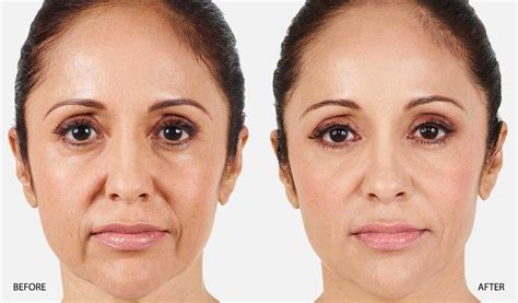 Juvederm Xc Before After Nasolabial Folds Dr Beth Comeau Md