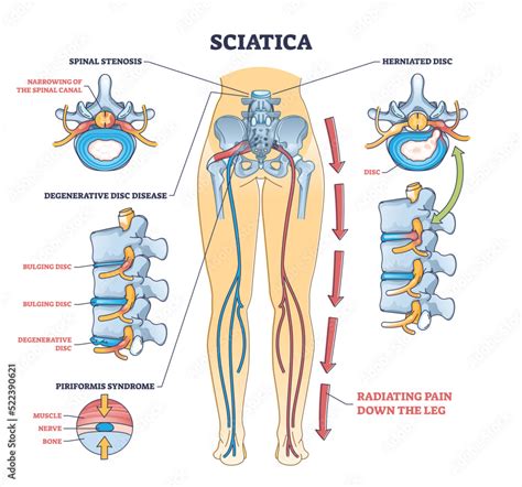 Sciatica Pain Or Nerve Weakness As Leg Lumbar Radiculopathy Outline