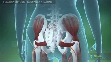 Sciatica During Pregnancy Anatomy Youtube