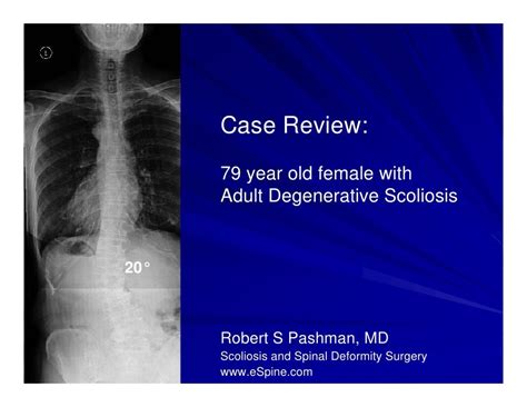 Case Review 18 79 Year Old Female With Degenerative Scoliosis