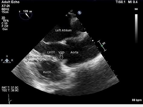 Transesophageal Echocardiogram Long Axis View Of The Aortic Valve Download Scientific Diagram
