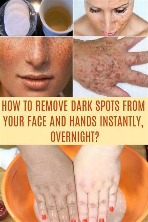 How To Get Rid Of Brown Spots On Face Brownagespots