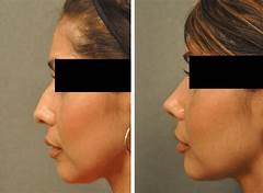 Nose Perfection In Tijuana Eoc Plastics Rhinoplasty Experts Will Shape Your Ideal Feature