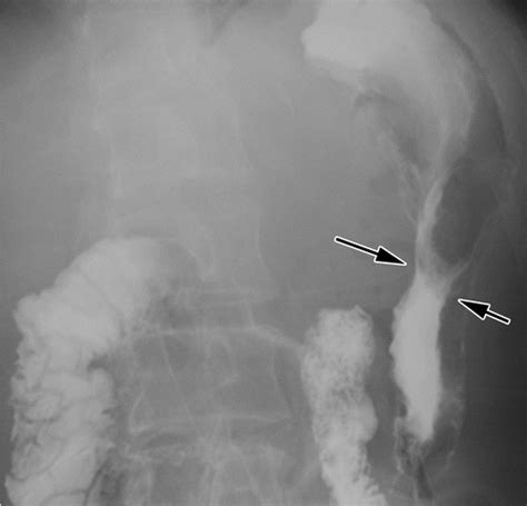 Ligaments And Lymphatic Pathways In Gastric Adenocarcinoma Radiographics