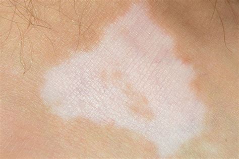 Psoriasis White Patches What Happens To Your Skin During