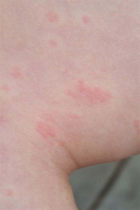 Beyond The Mirror What Cold Induced Urticaria Looks Like