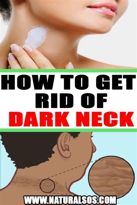 How To Get Rid Of Dark Neck Acanthosis Nigricans Dark Patches On