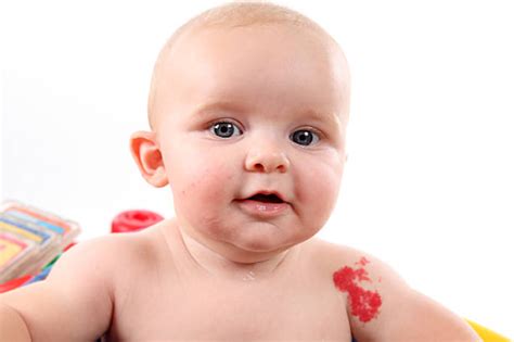Types Of Birthmarks In Babies — Causes Side Effects And Treatment
