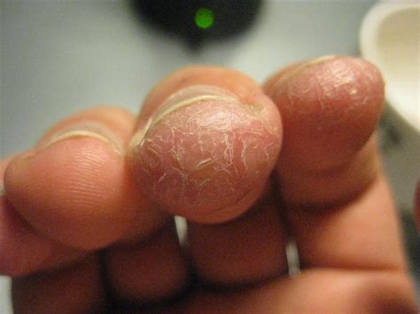 Unknown Dry Derm Condition On Finger Tips Psoriasis Inspire