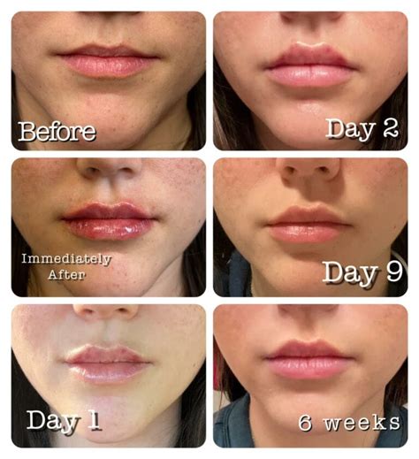 Lip Filler Swelling Stages Central Texas Dermatology