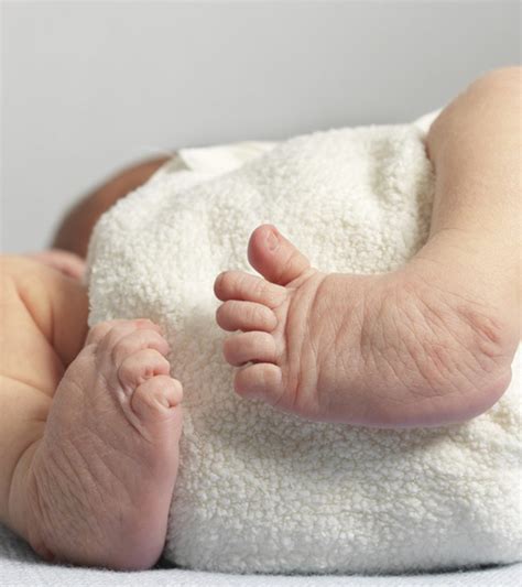 Clubfoot In Baby Causes Diagnosis Treatment And Pictures