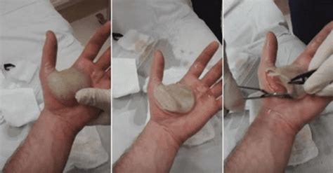 Watch Disgusting Video Of A Man Popping A Blister With A Size Of His