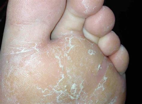 ATHLETE S FOOT DISCUSSED BY A PODIATRIST