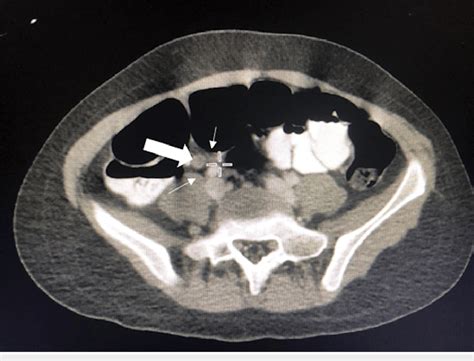 Computed Tomography Ct Abdomen With Contrast Showing Mildly Inflamed
