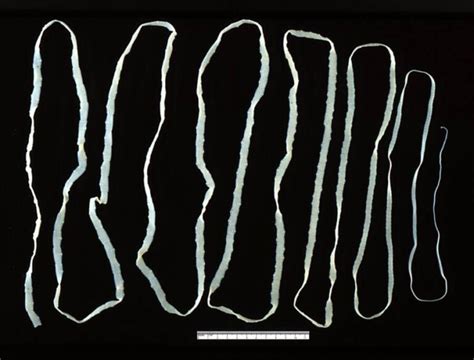 Boston Mans Mysterious Seizures Caused By Tapeworms In His Brain