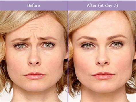Worry Lines And Wrinkles Can Really Age You More Than Youd Like Take A Look At This Botox
