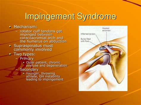 Ppt Shoulder Pain Powerpoint Presentation Free Download Id3830277