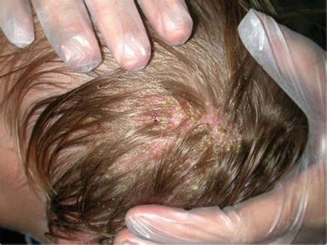 A Case Report Of Tinea Capitis In Infant In First Year Of Life Bmc