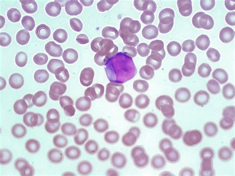 Acute Myelogenous Leukemia Aml A Laboratory Guide To Clinical
