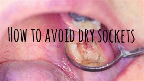 How Not To Get A Dry Socket Youtube