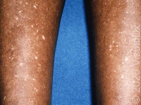 Light Brown Spots On Lower Legs Infoupdate Wallpaper Images