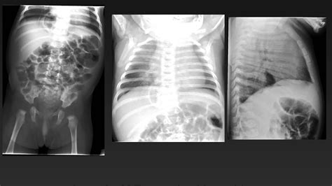 The radiologist should be able to see (in no specific order) your stomach, air in your large and small. Normal Abdominal X Ray In Neonates - slidedocnow