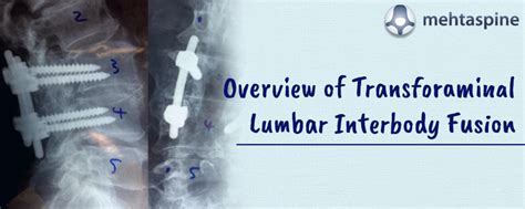 Overview Of Transforaminal Lumbar Interbody Fusion