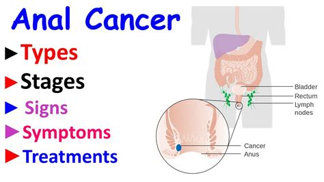 Anal Cancer Intro Types Stages Signs Symptoms And Treatment