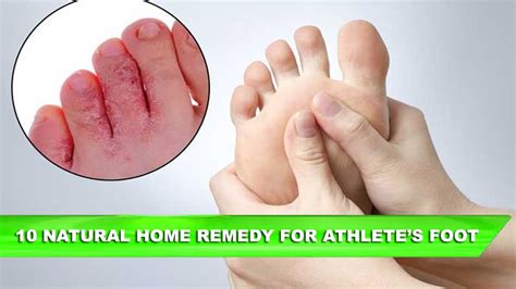 10 Natural Home Remedies For Athletes Foot Youtube
