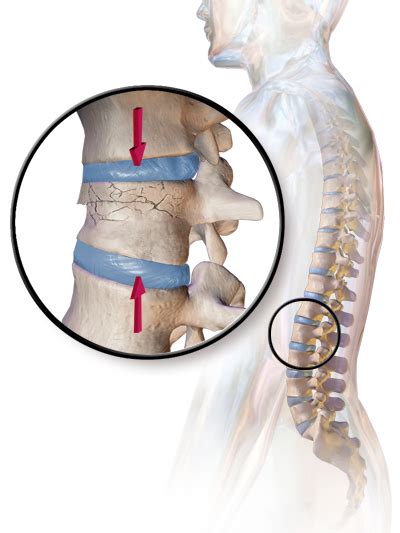 Lumbar Compression Fracture Treatment Surgery