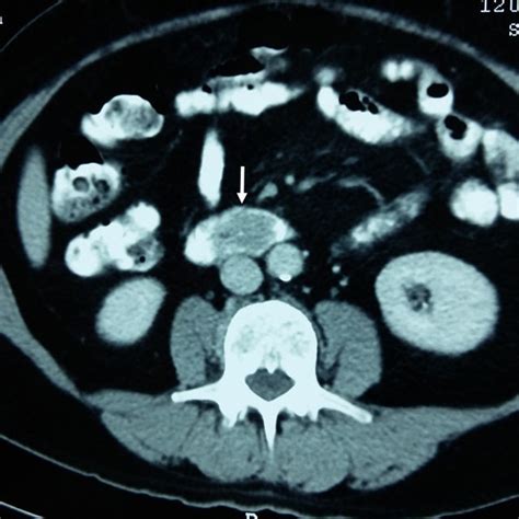 Axial Ct Scan Of The Abdomen After Iv Contrast Medium Administration