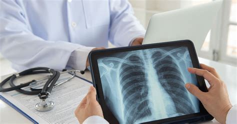 Expanded Lung Cancer Screening Guidelines Designed To Catch More Cases