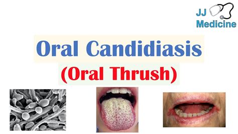 Oral Candidiasis Oral Thrush Causes Pathophysiology Signs