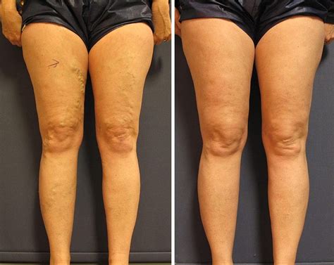 Varicose Vein Treatment Before And After Vein Photos