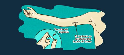 Implantes Subd Rmicos M Todos De Anticoncepci N Universidad Eafit