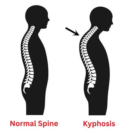 Kyphosis Understanding The Condition And How To Manage It Orthorelieve