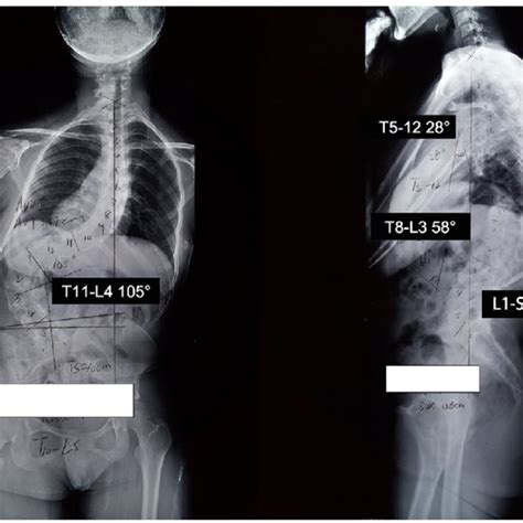 Post Operative Standing Anteroposterior And Lateral Radiographs
