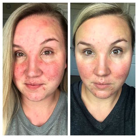 Rosacea Treatment Results Proskin Clinics