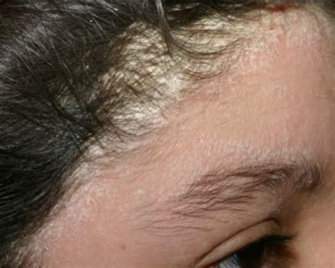 Seborrheic Dermatitis A Skin Condition That Shashwat Ayurveda